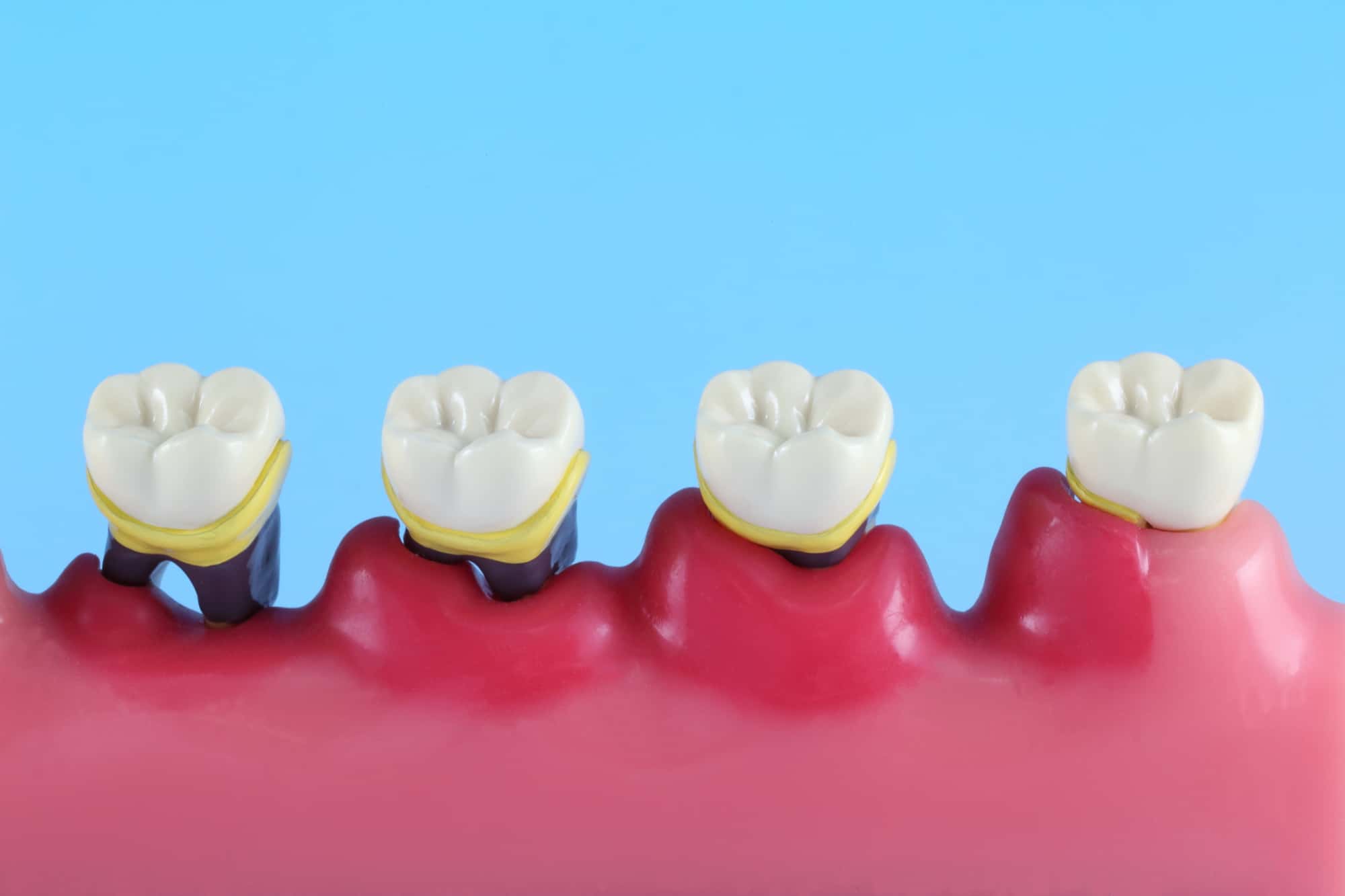 歯周病の進行のイメージ