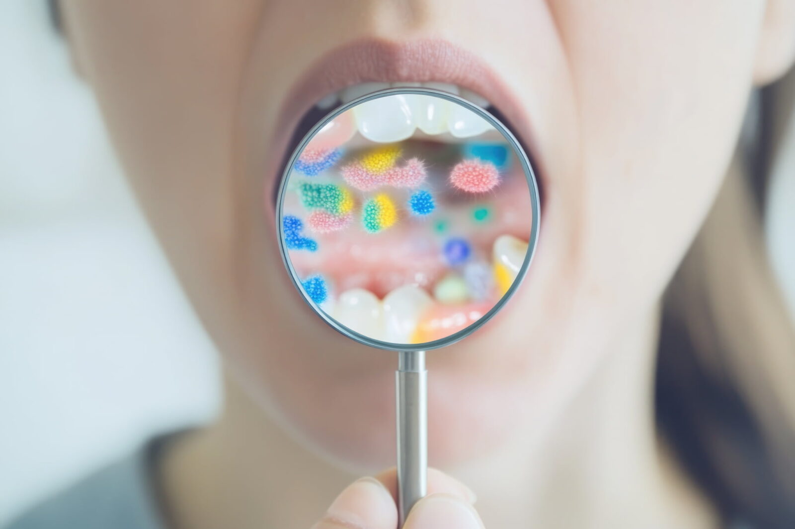 インプラント周囲炎の主な原因イメージ