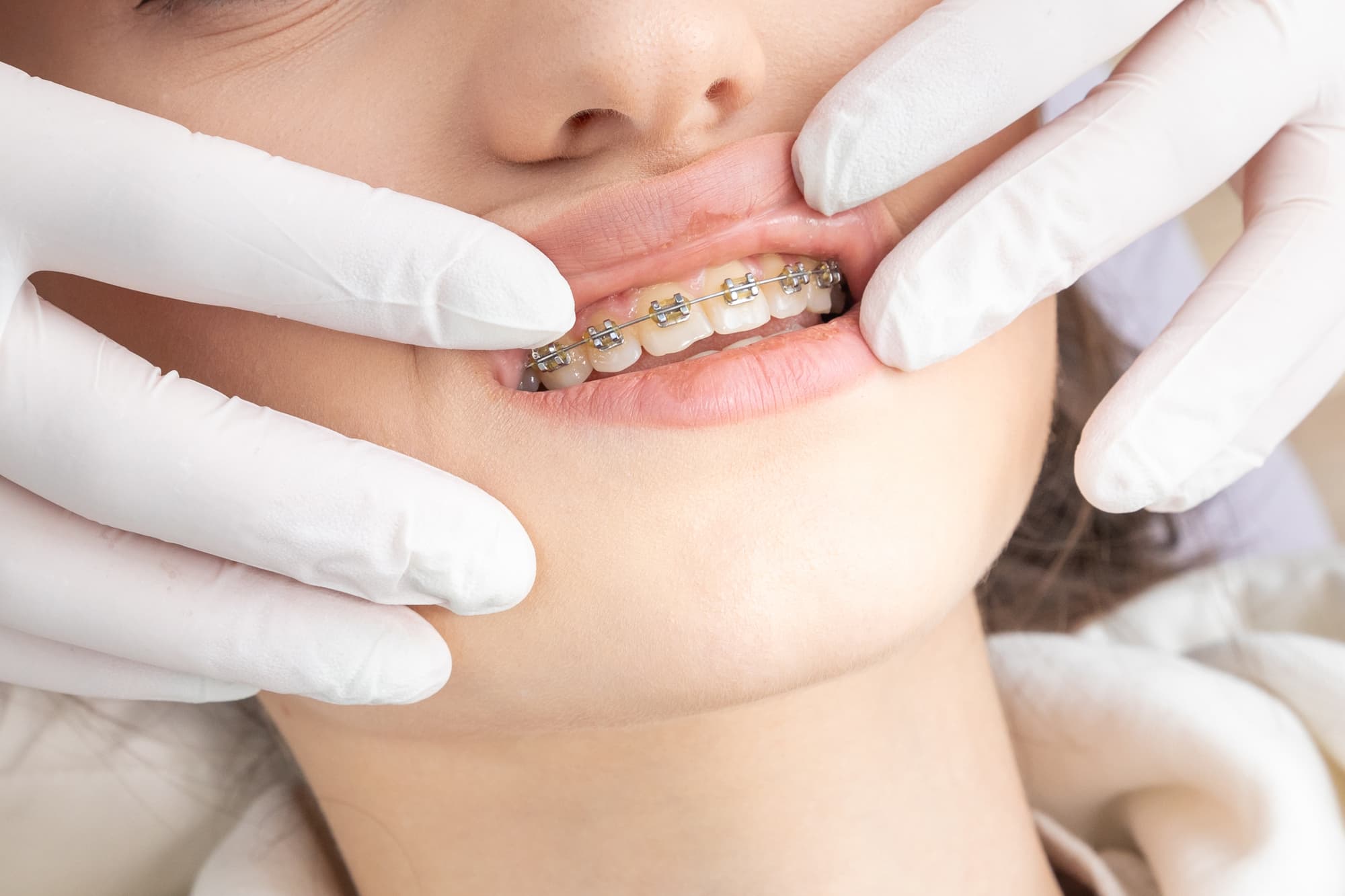 ワイヤー矯正をしている歯