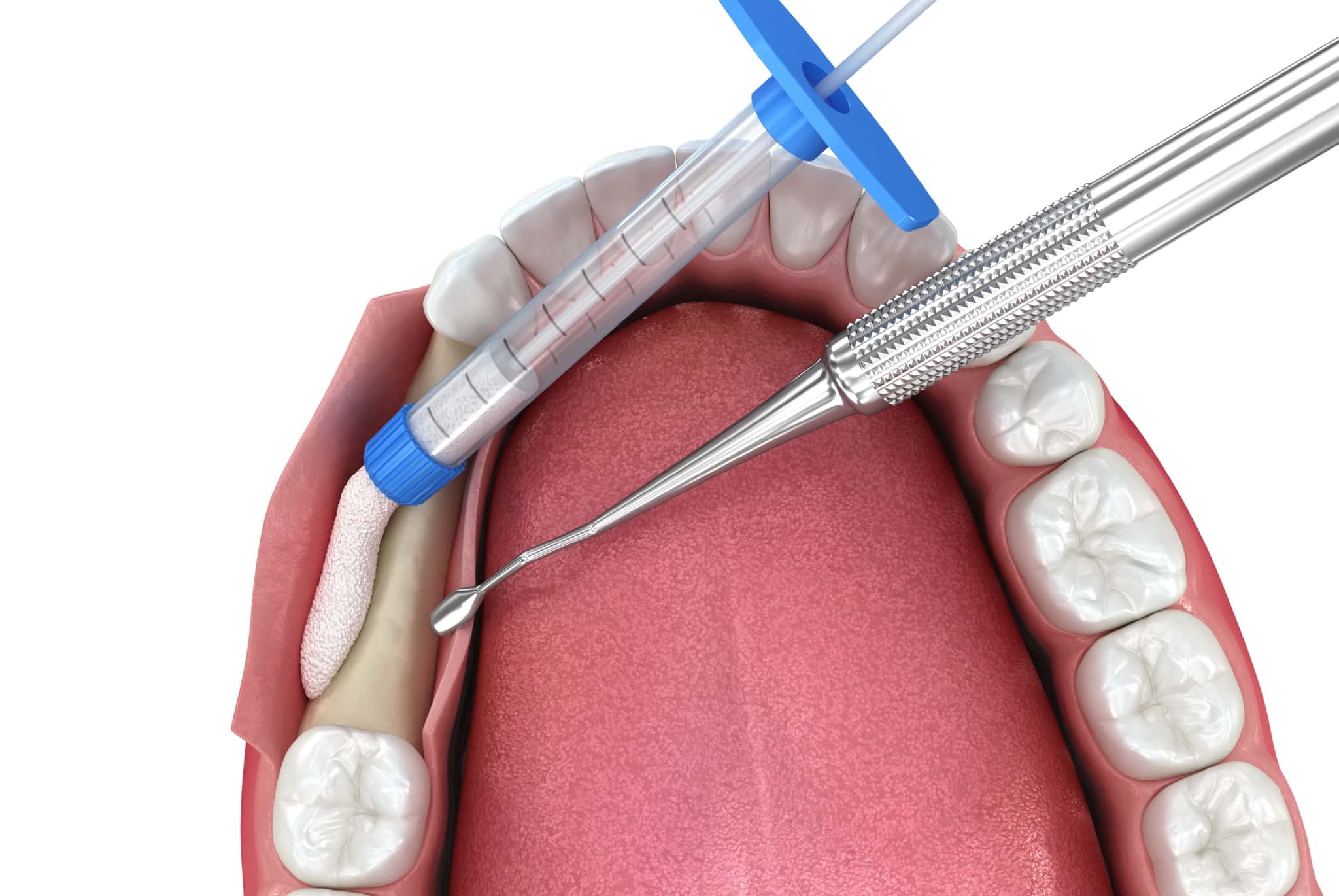 骨を再生させる治療のイメージ