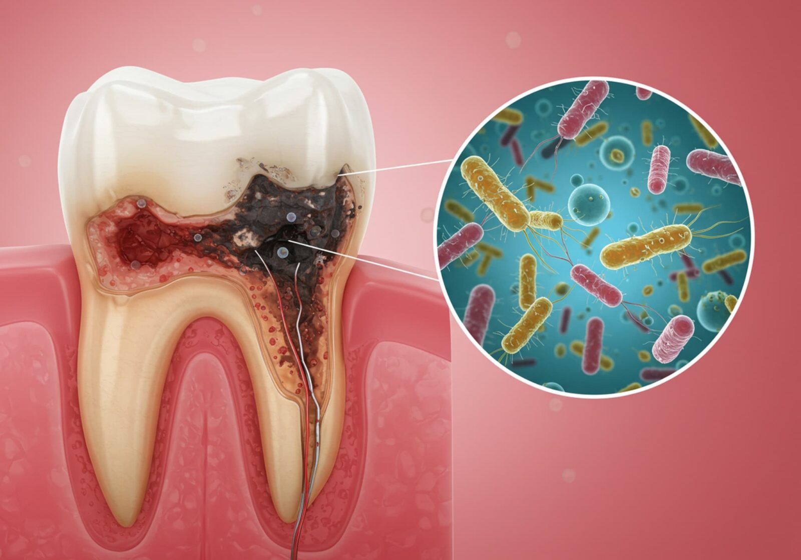 歯の根管内に侵入した虫歯菌のイメージ
