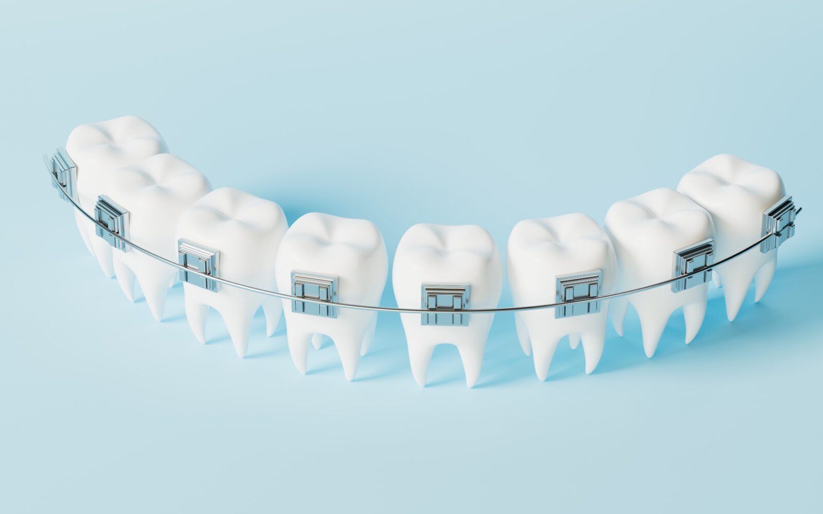 歯の模型に装着したワイヤー矯正装置